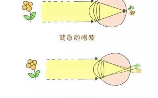 散光的是什么镜，散光是什么原因造成的