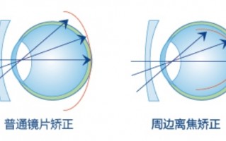 镜片的度数取决于什么，镜片的度数取决于什么因素